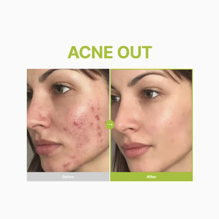 Purito SEOUL Azelaic Acid 10 Kojic Tea Tree Serum 30ml