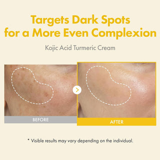 TOSOWOONG Kojic Acid Turmeric Cream 50ml for Dark Spots & Hyperpigmentation